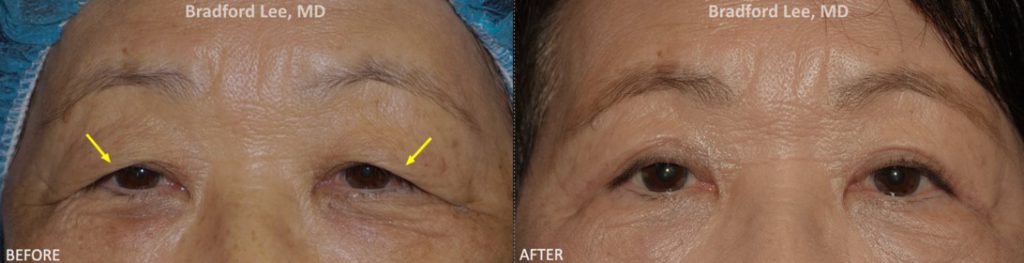 This 74-year-old female presented with significant excess skin and difficulty seeing peripherally. She underwent a upper lid blepharoplasty to improve her vision and remove the excess skin.