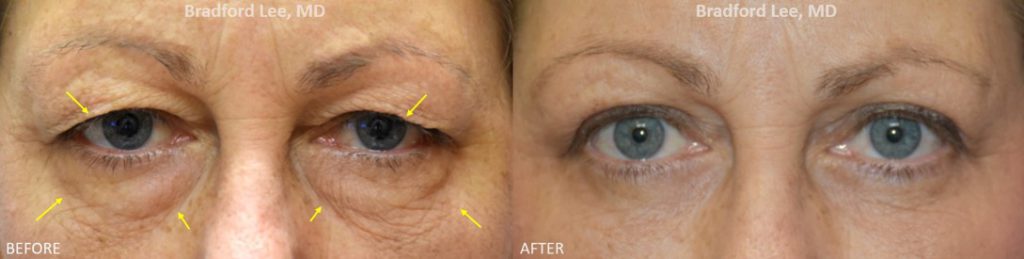 This 51-year-old lady complained of the excess skin that was resting on her eyelashes and preventing her from applying eye makeup. She was also bothered by the puffiness and skin textural changes of the lower eyelids. She underwent an upper and lower blepharoplasty for a dramatic yet natural-appearing enhancement of the upper and lower eyelids.