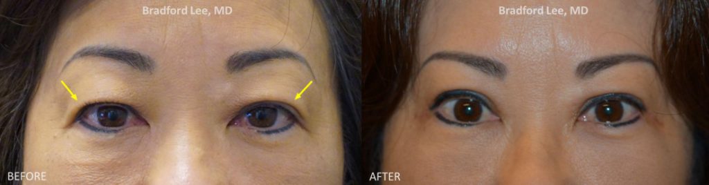 This 56-year-old patient complained of reduced peripheral vision due to her droopy upper eyelids. She underwent an upper lid blepharoplasty to improve her vision and achieve a rejuvenated and brighter look.