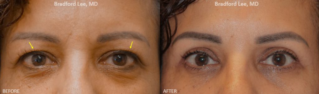 This patient in her 40’s was bothered by the hooded skin of her upper eyelids giving her a tired appearance. She underwent an upper lid blepharoplasty surgery to remove the excess skin and give her eyes a more youthful and awake appearance.