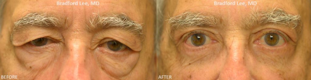This 76-year-old male was bothered by lateral drooping of the eyebrows, excess upper eyelid skin, and prominent fat prolapse on the lower eyelids. He underwent a lateral brow lift and quad blepharoplasty for a dramatic yet natural-appearing improvement of the entire periocular region.