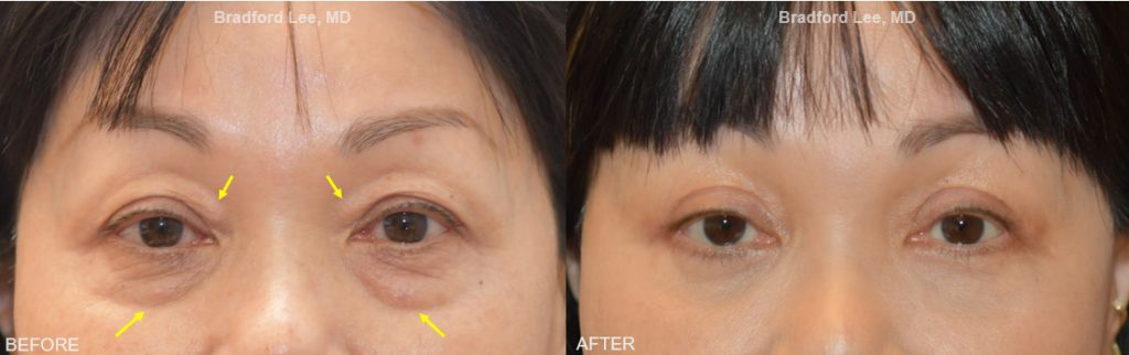 This female patient was interested in a more rejuvenated and refreshed appearance. She underwent a quad blepharoplasty with fat repositioning and skin pinch excision. *This photo was taken at 3 months post-op, and the mild residual redness/swelling will continue to resolve over time.*