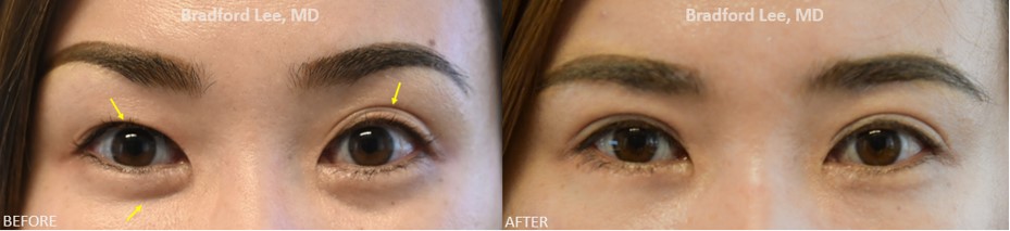 This 30-year-old female had a “suture method” double eyelid surgery done elsewhere. She was bothered by poor crease visibility on the right upper eyelid, multiple creases on the left upper eyelid, and puffiness of the right lower eyelid. She opted for a revision Asian double eyelid surgery to create well-defined creases on both sides, a right lower lid blepharoplasty to reduce excess puffiness, and a lateral canthoplasty to give her eyes a more almond-shaped appearance.