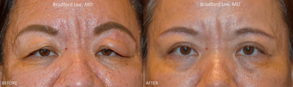 This 49-year-old female was bothered by the excess skin and heaviness of her brows. She underwent a upper blepharoplasty to remove the excess skin and a brow lift was performed to elevate the level of the brows. *This photo was taken at 3 months post-op, and the mild residual redness/swelling will continue to resolve over time.*