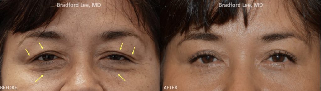 This 58-year-old female complained of excess skin on the upper and lower lids as well as droopiness that made her appear tired. She underwent an upper and lower lid blepharoplasty with a conservative ptosis repair to give her a refreshed and youthful appearance.