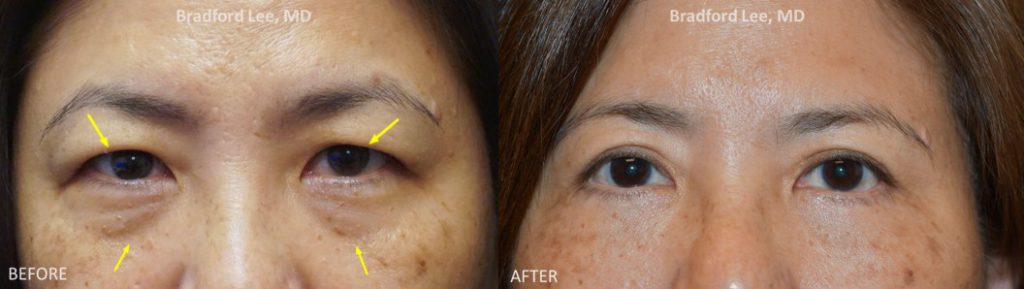 This 50+ year-old Asian lady was bothered by the puffiness of the upper lids, excess skin, and lack of a visible eyelid crease but wanted something very conservative and natural-looking. She was also bothered by subtle fat prolapse, excess skin, and hollowing along the lower eyelids. She underwent an Asian upper blepharoplasty with lid crease formation and a fat-transposition lower blepharoplasty, resulting in a visible upper eyelid crease and refreshed appearance.