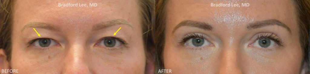 This 38-year-old patient was bothered by excess skin and hooding to the upper eyelids. She underwent a upper lid blepharoplasty to address the sagging skin and preserve a youthful yet natural appearance. She is now able to successfully apply her eye makeup.