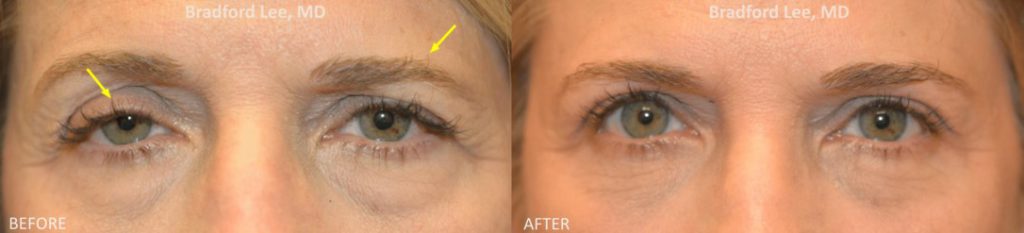 This 57-year-old patient presented with ptosis of the upper eyelids that made her look tired with an asymmetrical appearance. She was also bothered by drooping of the left brow. This patient underwent a bilateral upper lid ptosis repair, upper blepharoplasty, and left brow ptosis repair to improve symmetry.