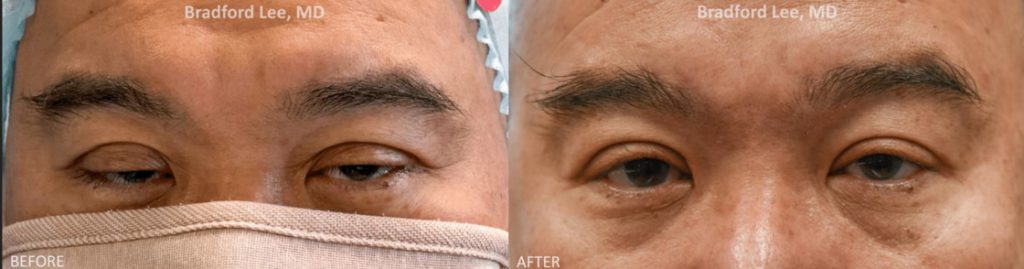 This 51-year-old male was bothered by significant drooping of the upper eyelids that were making it difficult to see. He opted for a bilateral upper lid ptosis repair to lift his upper eyelids, allowing more light into the eye and improving his vision. *This photo was taken at 3 months post-op, and the mild residual redness/swelling will continue to resolve over time.*
