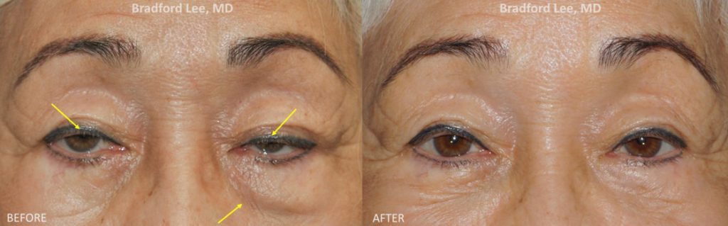 This 72-year-old lady presented with droopy upper eyelids and excess puffiness on the left lower eyelid. The patient underwent a conservative upper lid ptosis repair to open her eyes, and a left lower lid skin-pinch blepharoplasty with a dermal filler injection to the left tear trough region to improve her lower lid symmetry.