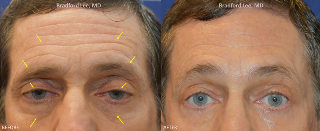 This 61-year-old patient presented with droopy upper eyelids and complained of looking “sleepy” all the time. The patient underwent a trichophytic brow lift with a ptosis repair and lower lid blepharoplasty to open up the eyelid complex for a brighter and more refreshed look.