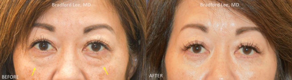 This beautiful patient in her 50’s complained of constantly looking tired. She underwent a lower lid blepharoplasty to tighten and rejuvenate the lower eyelid skin.