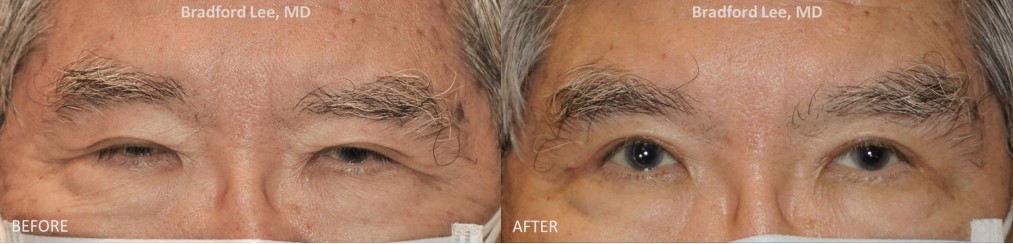 This 73-year-old patient was bothered by the drooping and heaviness of his upper eyelids. He underwent an upper lid blepharoplasty with a ptosis repair to improve his vision and quality of life. Results shown are 7 weeks after surgery.