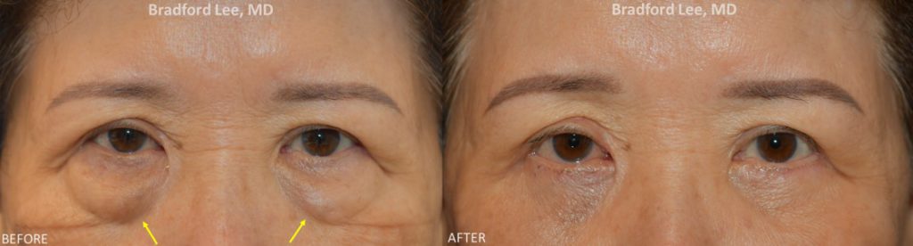 This 75 year-old patient was bothered by the puffiness of the lower lids. She underwent a lower lid blepharoplasty to remove the excess fat as well as fat reposition to achieve a smoother appearance of the under eye 