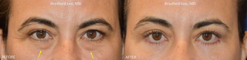 This 47-year-old lady complained of puffiness of the lower lids and under eye hollowing that extended into the cheeks. She underwent a lower lid blepharoplasty resulting in a natural but youthful enhancement of the lower lids.