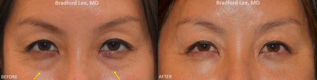 This young patient was starting to notice mild puffiness and hollowing to the lower eyelids. She underwent a lower lid blepharoplasty to smooth out her lower eyelid contour and reduce the appearance of shadowing.