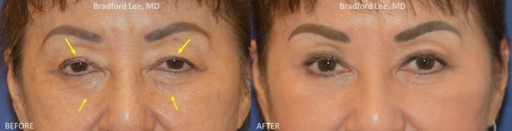 This patient was experiencing discomfort from the heaviness of her upper eyelids and was looking for a more youthful and refreshed appearance. She underwent a quad blepharoplasty and ptosis repair to address the droopiness and excess skin on her upper eyelids and under-eye “bags.”