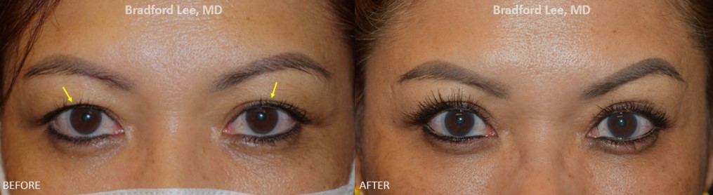 This patient, who is her 40’s, was bothered by the excess skin of her upper eyelids and felt that she couldn’t apply her makeup or lashes properly. She underwent an upper blepharoplasty to remove the excess skin, define her eyelid creases, and restore her eyes to their youthful attractiveness She is now able to apply her beautiful eye makeup.