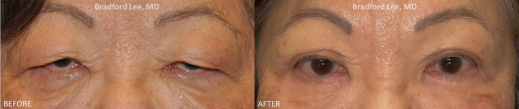 This 74-year-old lady presented with severe upper lid ptosis and excess skin of the upper and lower eyelids. She underwent an upper blepharoplasty with ptosis repair and lower blepharoplasty resulting in a dramatic yet natural-appearing enhancement of the upper and lower eyelids. *This photo was taken at 3 months post-op, and the mild residual redness/swelling will continue to resolve over time.*