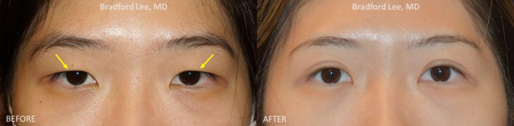 This 22-year-old patient was bothered by the size of her eyes, the lack of an upper eyelid crease, and prominent epicanthal folds. She underwent an Asian upper blepharoplasty and epicanthoplasty to create a natural eyelid crease and soften the epicanthal folds to show more of the white on the inner corner of her eyes.