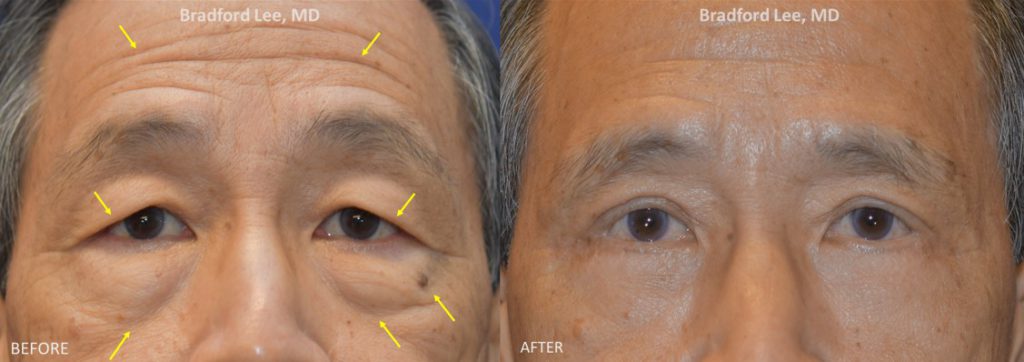 This 71-year-old male was bothered by the heaviness of his brows, excess skin on the upper eyelids, 