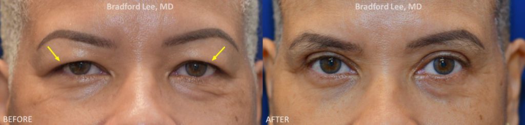 This lovely patient complained of the puffiness and drooping of her upper eyelids. She underwent an upper blepharoplasty to remove the excess skin and reshape the eyelids to achieve a harmonious and rejuvenated look.