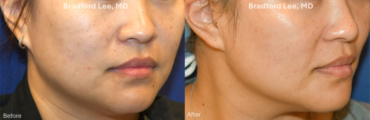 This lovely patient wanted to improve the texture, tone, and overall appearance of her skin. She underwent 1 session of microneedling with improvement in skin texture and tone to her skin resulting in a healthy glow-up.