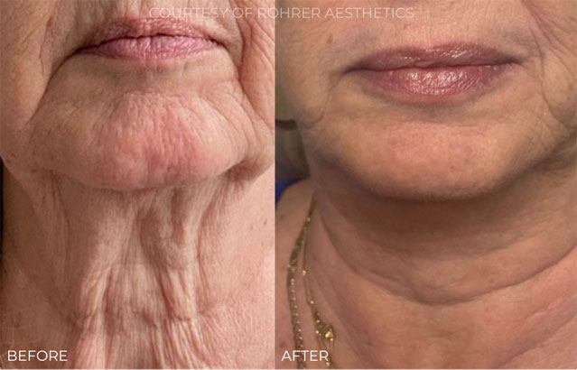 rf microneedling before after image1