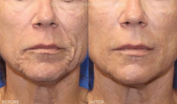 rf microneedling before after image2