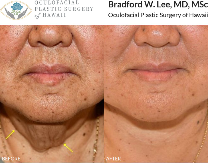 This 64-year-old patient was bothered by fullness and excess skin in the neck region and wanted a more defined jawline. She underwent a neck lift with submental liposuction to remove the excess skin and fat, giving her a more contoured neck and jawline.