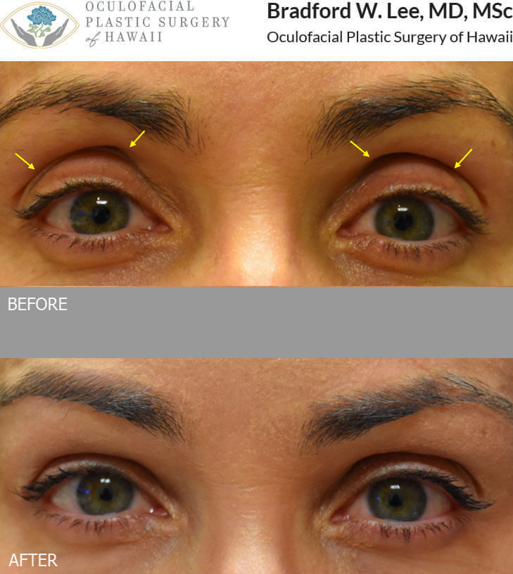 Lid Injection Dermal Fillers | Oculofacial Plastic Surgery of Hawaii