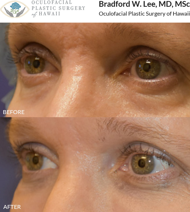 52F Filler to Periorbital Hollows