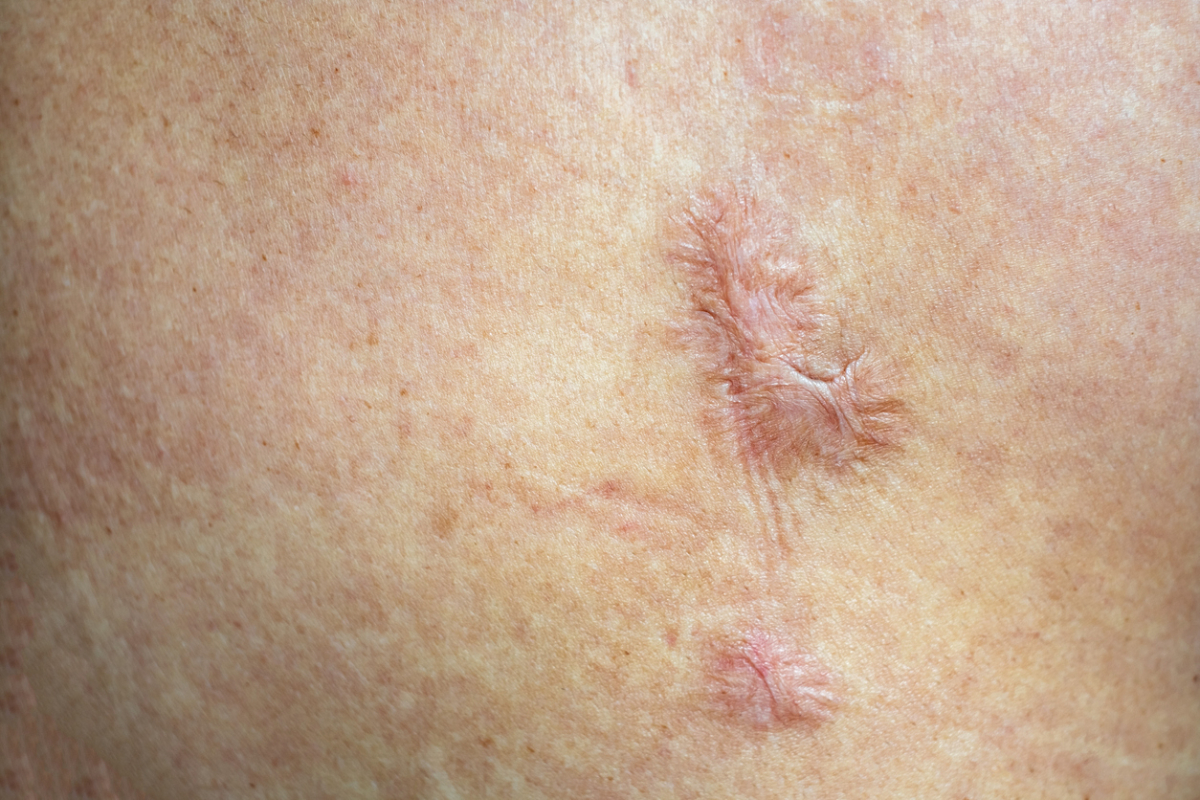 Featured image for Are Scars Permanent?