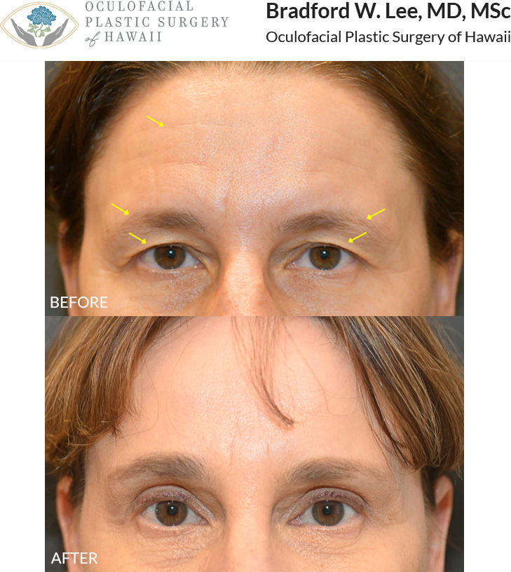 This patient in her 50s was bothered by heaviness of the brows and upper eyelids as well as forehead aging. She underwent a trichophytic brow and forehead lift with upper blepharoplasty to enhance and open her eyes with a natural, brightened, and refreshed result.