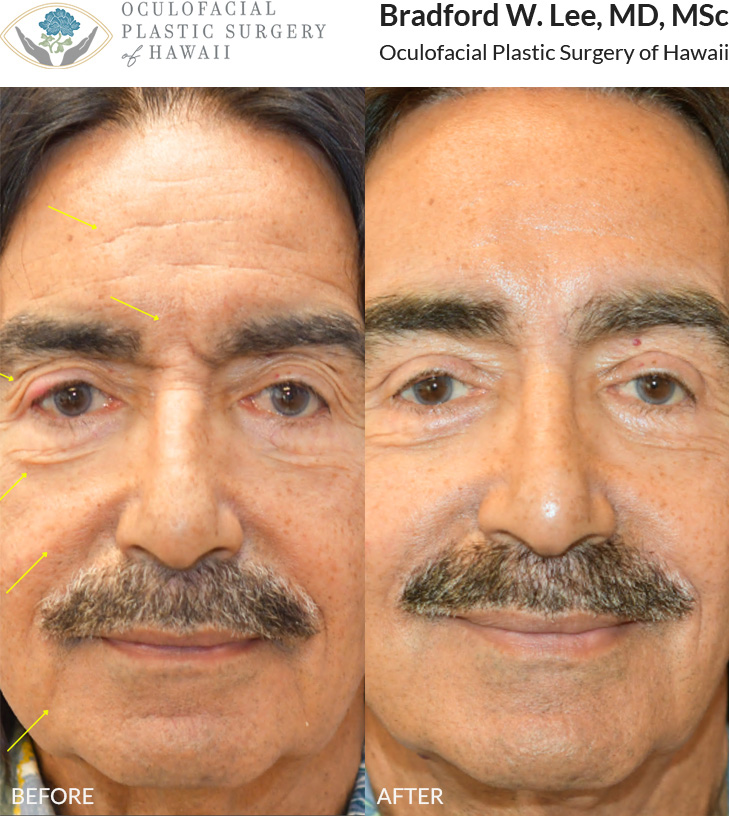 This patient in his 70s was bothered by the excess skin on his upper and lower eyelids, as well as heavy brows and aging of the forehead. He underwent a trichophytic brow and forehead lift with bilateral upper lid blepharoplasty and a right lower lid blepharoplasty to enhance the eyes and upper face resulting in a natural rejuvenation of these areas. He also opted for global facial and neck rejuvenation with a simultaneous face and neck lift.