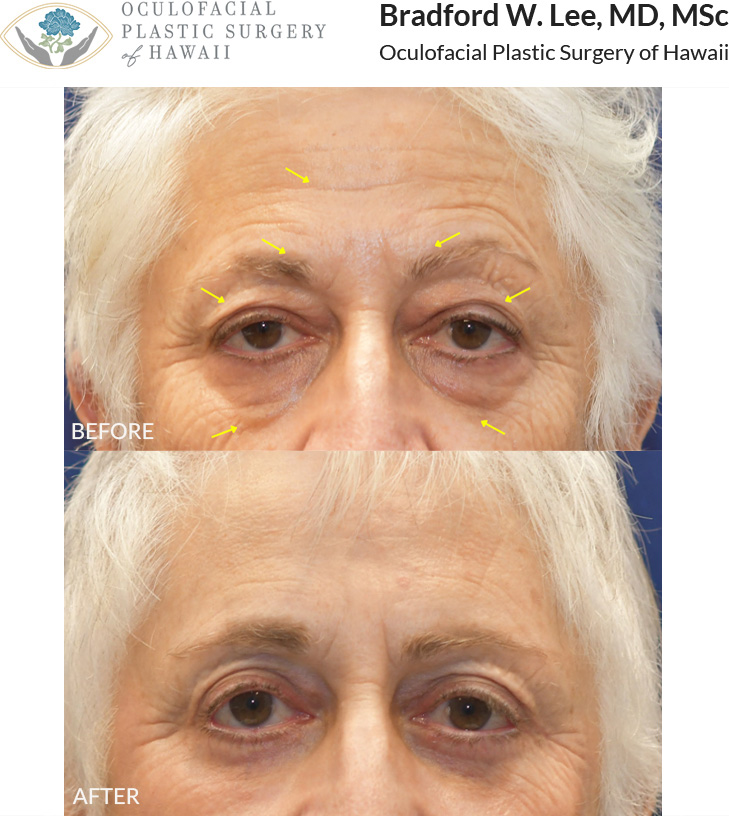 This patient in her 70s was bothered by the heaviness of her brows and upper eyelids, as well as puffiness of the lower eyelids and forehead aging. She underwent a trichophytic brow and forehead lift with upper and lower blepharoplasty to address these concerns. She also underwent CO₂ laser skin resurfacing to rejuvenate her global skin quality and address textural changes and wrinkles, resulting in more youthful, smoother, and brighter skin.