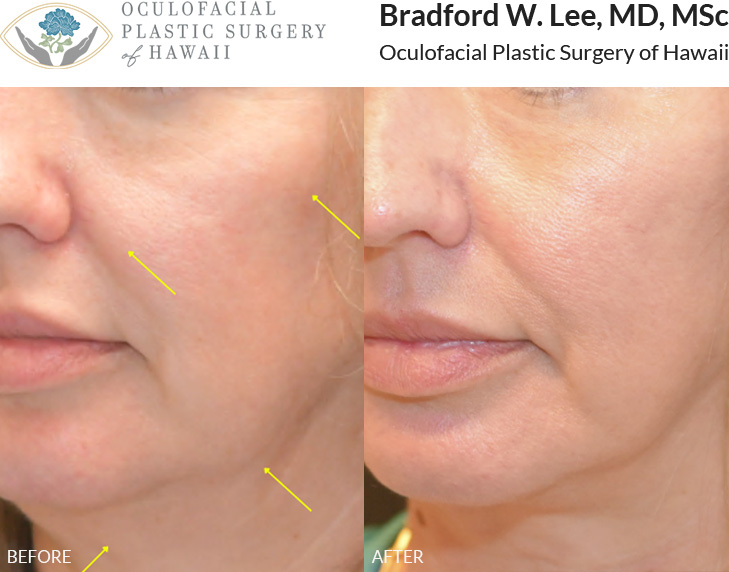 This patient in her early 50s was concerned with jowling and gravitational facial descent. She underwent a face and neck lift resulting in a more youthful contour to the cheeks and a more defined neck and jawline.