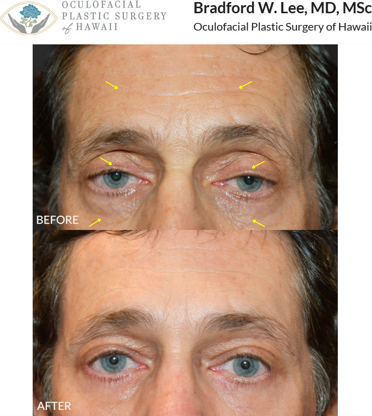 This patient in his 60s was bothered by the heaviness of his upper eyelids, puffiness of the lower lids, and forehead aging. He underwent a ptosis repair with trichophytic brow and forehead lift and lower blepharoplasty to enhance, brighten, and rejuvenate the eye, brow, and forehead region while still maintaining a natural look.