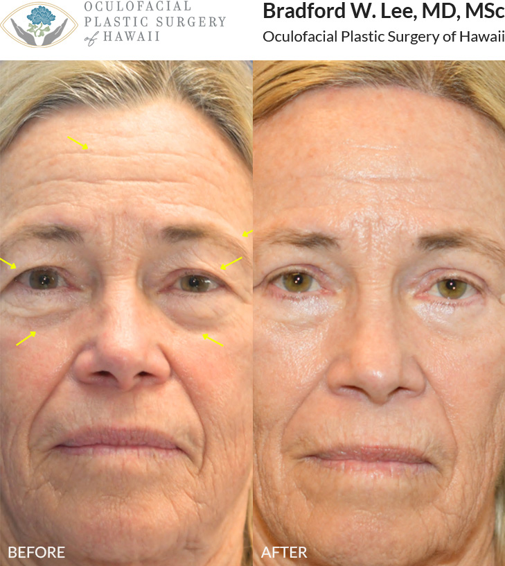 This patient in her 70s was bothered by heaviness of the brows and aging of the upper and lower eyelids. She underwent a trichophytic brow and forehead lift with upper and lower blepharoplasty to rejuvenate the eyes and upper face.