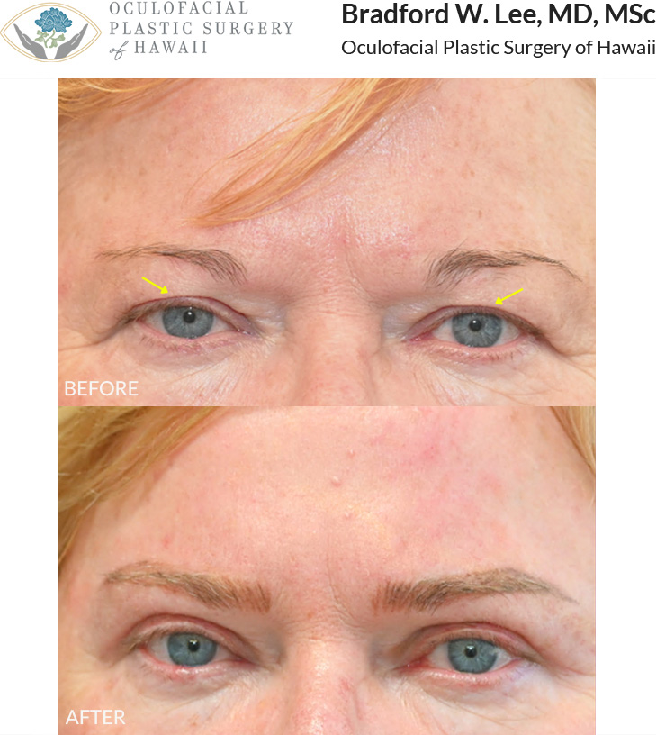 This patient in her 60s was bothered by heavy brows and excess skin on the eyelids and wanted a more refreshed look to her upper lids and brows. She underwent an upper blepharoplasty with a trichophytic brow lift to enhance her eyes and brow complex.