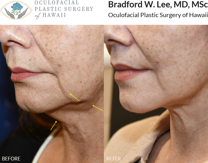 This patient in her 60s was noticing gravitational changes including jowling and neck and jawline laxity. She underwent a face and neck lift with a very natural-looking improvement in her cheek, jawline, and neck contours.
