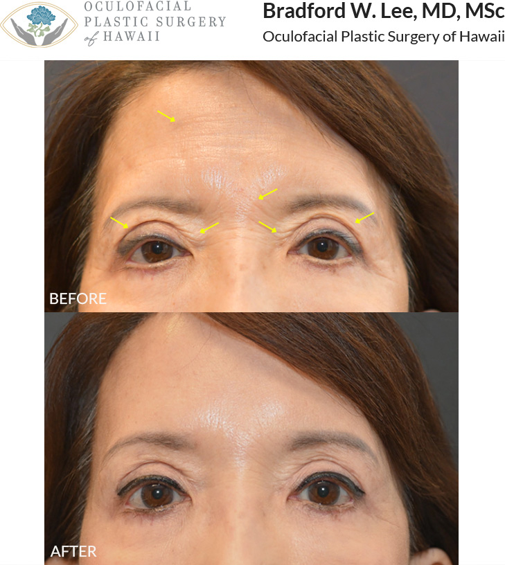 This patient in her 60s had upper eyelid surgery done by another surgeon and was bothered by residual puffiness of the upper eyelids, as well as wrinkling of the eyelid, forehead, and area between the brows. She underwent a revisional upper blepharoplasty with a trichophytic brow and forehead lift to achieve a more youthful, lifted, and rejuvenated eye and forehead appearance.
