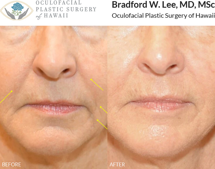 This patient in her 60s was bothered by gravitational facial descent and lower eyelid bags. She underwent a mini facelift to restore a youthful contour to the cheek, perioral, and smile line regions for a natural and refreshed look.