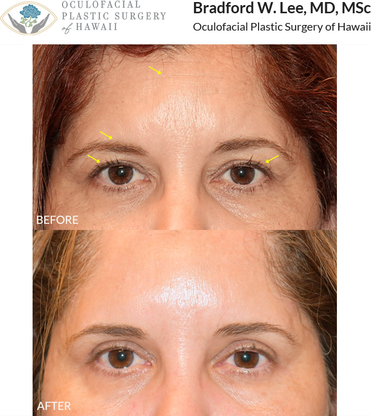 This patient in her 40s was concerned about brow drooping, asymmetry, forehead wrinkles, and upper eyelid hooding. She underwent an upper blepharoplasty with a trichophytic brow and forehead lift to further lift the upper eyelids, open the eyes, and create a more refreshed, youthful appearance.