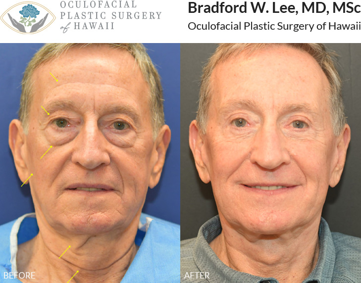 This patient in his mid-70s was bothered by gravitational changes of the face and neck resulting in midface descent, jowling, and neck laxity. He underwent a (? upper and lower blepharoplasty) face and neck lift with a noticeably refreshed and natural-looking result.