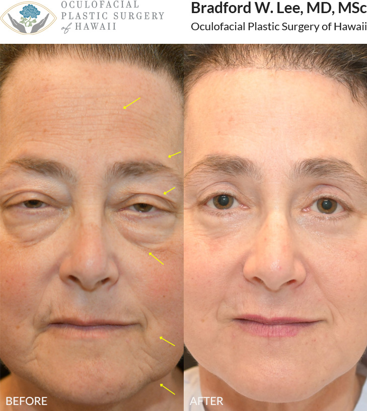 This patient in her 50s was bothered by drooping of the eyelids and brows and felt they were giving her a tired and stern appearance. She underwent a trichophytic brow lift with upper and lower blepharoplasty and ptosis repair to rejuvenate her upper face and periocular region. This resulted in a dramatic enhancement of the youthfulness and emotional expression of her eyes. She also had a face and neck lift with perioral CO2 laser skin resurfacing for global face and neck rejuvenation.