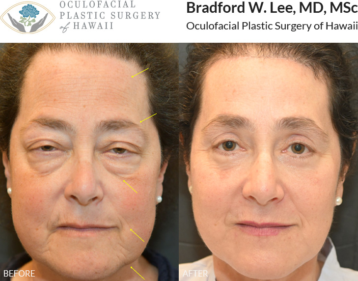 This patient in her 50s was bothered by drooping of the upper and lower lids, brows, and aging of the face and neck. She underwent a global facial rejuvenation including a brow and forehead lift, upper lid ptosis repair, upper and lower blepharoplasty, and face and neck lift giving her a vibrant and refreshed look.