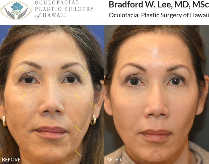This patient was bothered by excess skin on the upper eyelids, as well as, jowling and gravitational facial descent. She underwent a quad blepharoplasty and mini facelift to restore a youthful contour to the cheek, perioral, and smile line regions for a natural and refreshed look.