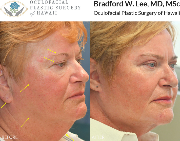 This patient was bothered by gravitational facial and neck aging, as well as, the drooping of her eyelids, brows, and ears. She underwent a face and neck lift, brow lift, upper blepharoplasty, and an otoplasty (earlobe repair) to give her a natural and elegant refresh.