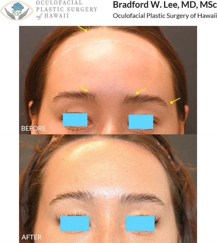 This beautiful patient in her 20s wanted to lower her hairline and reduce the size of her forehead to balance her facial proportions. She chose a trichophytic brow lift with hairline advancement to lower her hairline, reduce her forehead, and create a natural, balanced brow position and a 